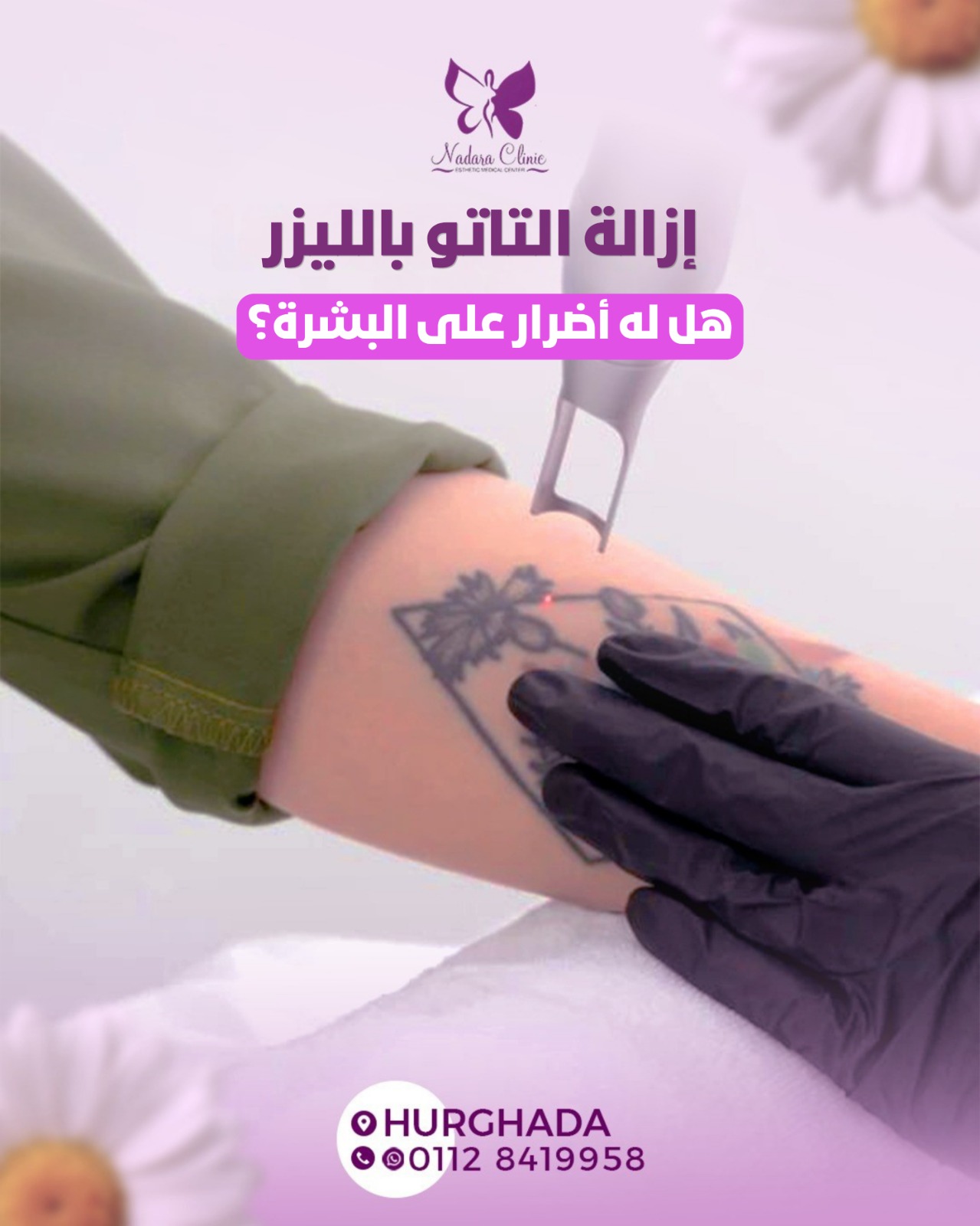 إزالة التاتو بالليزر في الغردقة